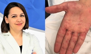 Dr. Ilsa Kraja: Prezenca e virusit Dorë-Gojë-Këmbë, çfarë duhet të dinë prindërit dhe edukatorët 